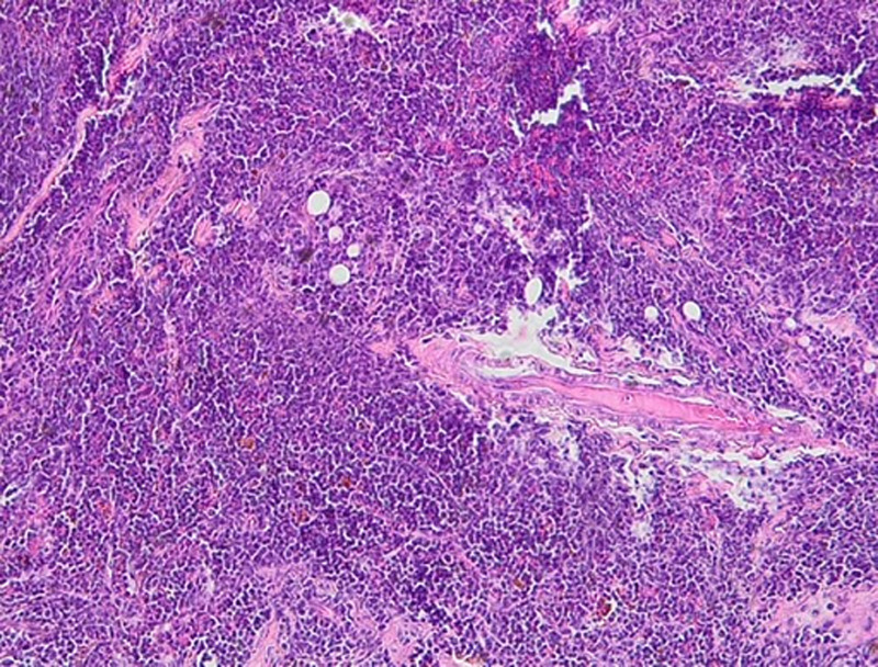 Ovarian relapse in a child with B-ALL: a case report.