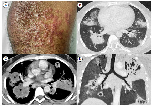 Granulomatosis with polyangiitis.
