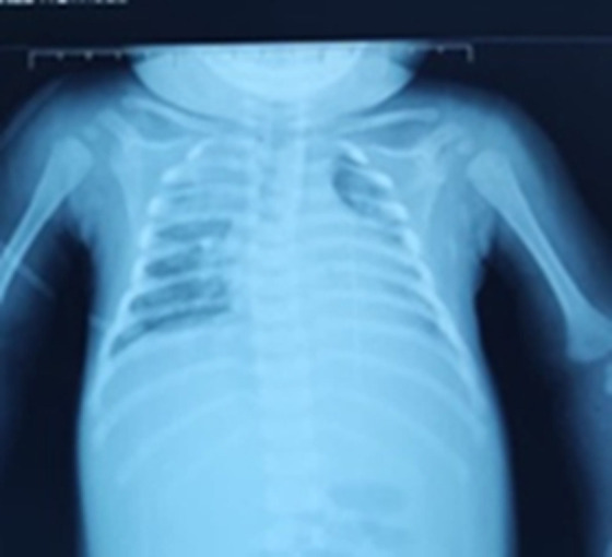 Diagnostic and therapeutic challenges of a heparin-induced thrombocytopenia in HIV immunodeficiency: in regards to a pediatric case (a case report).