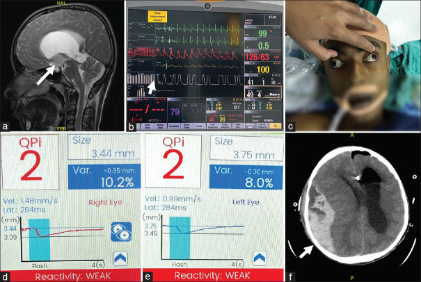 Pupillometry: A loupe to mirror intracranial status during recovery after neurosurgery.