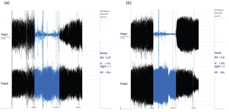 Impact of SGLT2 inhibitors on endothelial function and echocardiographic parameters in dilated cardiomyopathy.