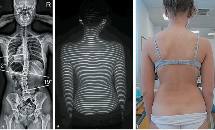Association between trunk aesthetics and underling scoliosis severity and curve type in adolescents: evaluation of traditional clinical scores and novel automated indices from rasterstereographic imaging.