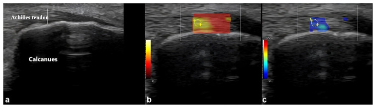 Ultrasonographic and elastographic evaluation of plantar fascia and Achilles tendon alterations in type 2 diabetes mellitus.