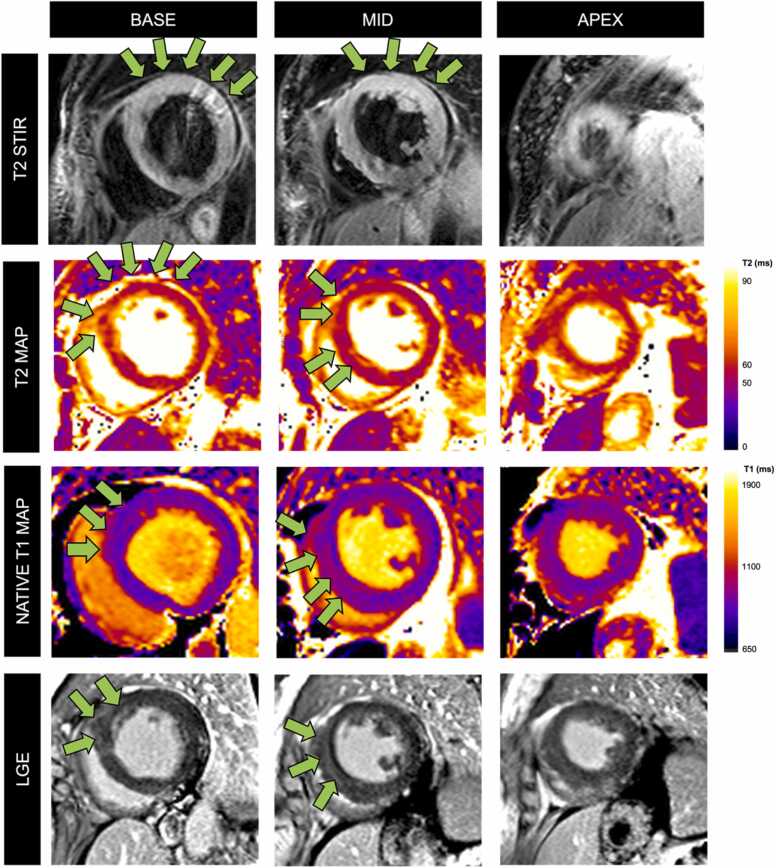 Diagnostic utility of the revised Lake Louise criteria in myocarditis associated with active autoimmune rheumatic disease.