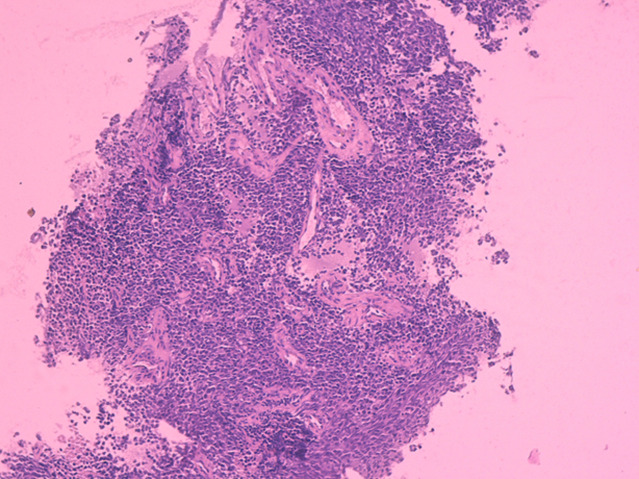 Ewing family tumors of soft tissue: a case report.