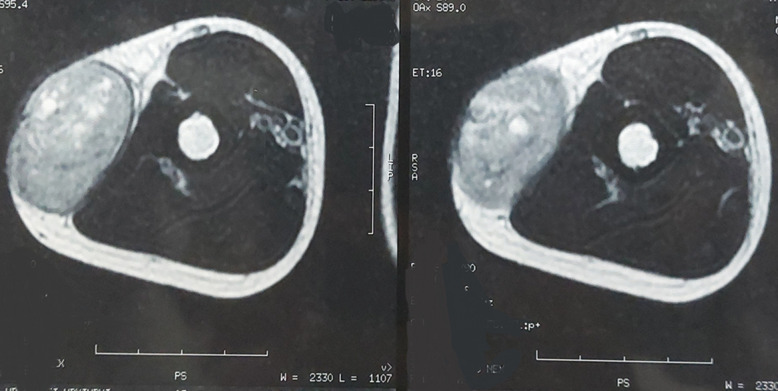 Ewing family tumors of soft tissue: a case report.