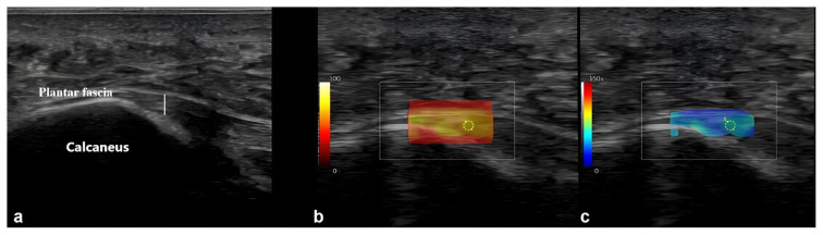 Ultrasonographic and elastographic evaluation of plantar fascia and Achilles tendon alterations in type 2 diabetes mellitus.