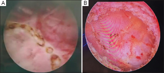 Neoadjuvant therapy plus thulium laser transurethral bladder tumor resection for muscle-invasive bladder cancer.