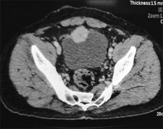Incidental paraganglioma of the urinary bladder: A case series highlighting a rare entity and a urologist's nightmare.