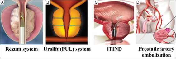 Minimally invasive surgical treatments for male lower urinary tract symptoms/benign prostatic enlargement: A review on sexual function outcomes.