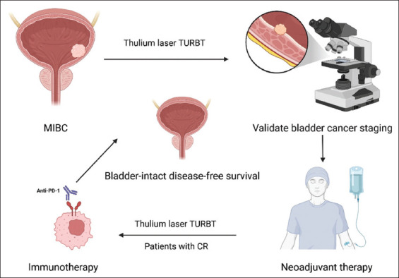 Neoadjuvant therapy plus thulium laser transurethral bladder tumor resection for muscle-invasive bladder cancer.