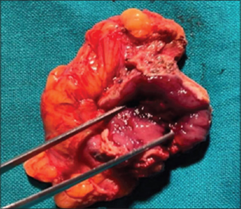 Incidental paraganglioma of the urinary bladder: A case series highlighting a rare entity and a urologist's nightmare.