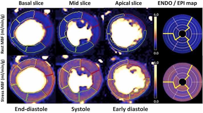 Normal values of high-resolution transmural perfusion distribution metrics for automated quantitative pixel-wise myocardial perfusion cardiovascular magnetic resonance.