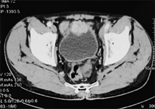 Incidental paraganglioma of the urinary bladder: A case series highlighting a rare entity and a urologist's nightmare.