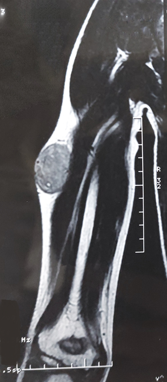 Ewing family tumors of soft tissue: a case report.