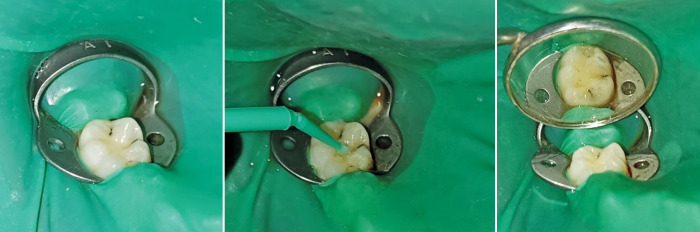 Comparative Efficacy of Dental Sealants, Silver Diamine Fluoride, and Nanosilver Fluoride in Pediatric Caries Prevention.