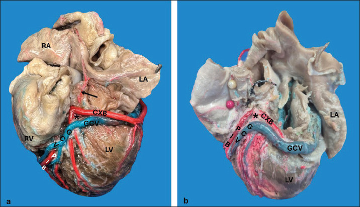 A direct anatomical characterization of the coronary sinus in dogs (<i>Canis lupus</i> familiaris).