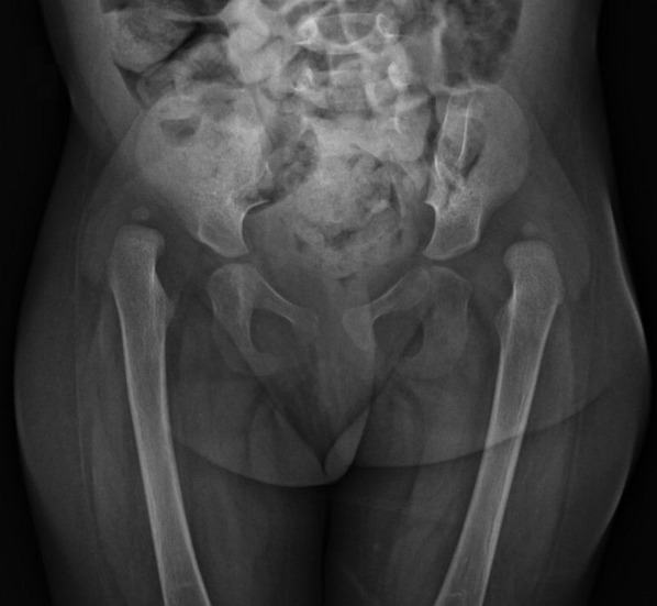 Cri du Chat Syndrome and congenital dislocation of the hips and knees: case report.
