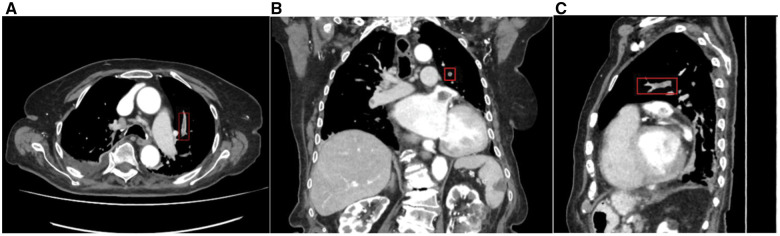 Deep learning-based algorithm for automatic detection of incidental pulmonary embolism on contrast-enhanced CT: a multicenter multivendor study.