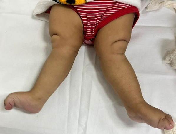 Cri du Chat Syndrome and congenital dislocation of the hips and knees: case report.
