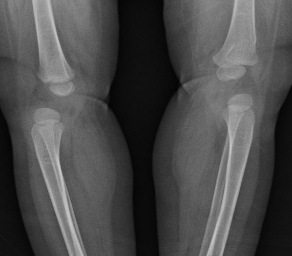 Cri du Chat Syndrome and congenital dislocation of the hips and knees: case report.