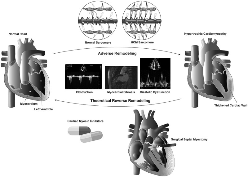 Favorable cardiac remodeling in response to treatment in obstructive hypertrophic cardiomyopathy: a current appraisal.