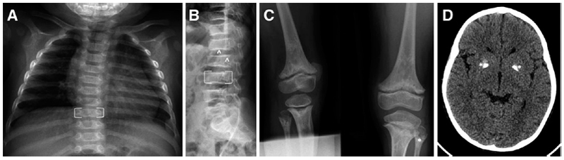 Spondyloenchondrodysplasia: An enigmatic immuno-osseus type I interferonopathy.
