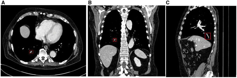 Deep learning-based algorithm for automatic detection of incidental pulmonary embolism on contrast-enhanced CT: a multicenter multivendor study.