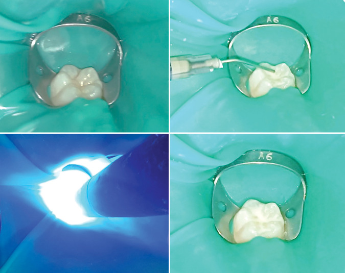 Comparative Efficacy of Dental Sealants, Silver Diamine Fluoride, and Nanosilver Fluoride in Pediatric Caries Prevention.