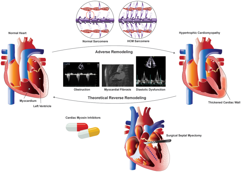 Favorable cardiac remodeling in response to treatment in obstructive hypertrophic cardiomyopathy: a current appraisal.