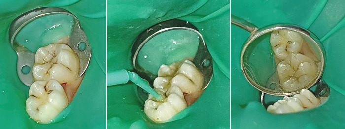 Comparative Efficacy of Dental Sealants, Silver Diamine Fluoride, and Nanosilver Fluoride in Pediatric Caries Prevention.