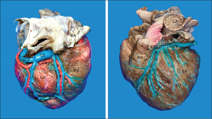A direct anatomical characterization of the coronary sinus in dogs (<i>Canis lupus</i> familiaris).