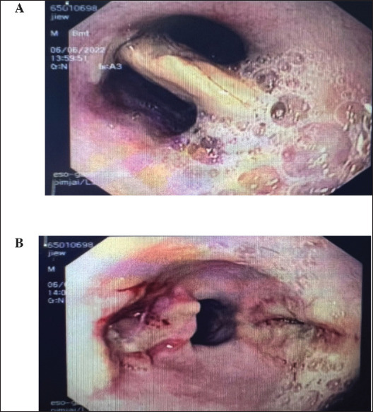 Prevalence and characteristics of foreign body-induced upper gastrointestinal obstruction in dogs.