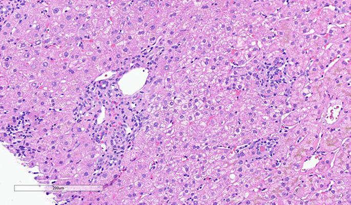 Chronic Enterovirus Meningitis with Acute Hepatitis in a Patient with Chronic Lymphocytic Leukemia Treated with Venetoclax/Obinutuzumab: A Case Report.