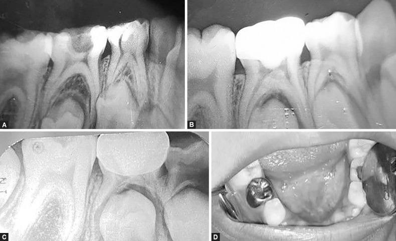 A Prospective, Blinded Randomized, Active-controlled Clinical Trial to Evaluate the Success of Double Antibiotic Paste in Pulpally Infected Primary Molars.