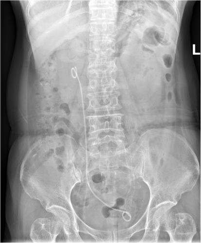 The allium stent for the complex ureteral stricture-deeper experience of a series case review
