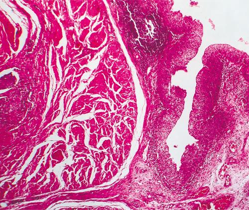FDA approves durvalumab for perioperative immunotherapy for patients with muscle-invasive bladder cancer