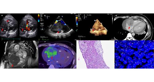 Rare Giant Cardiac Malignancy: Primary Cardiac Synovial Sarcoma