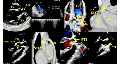 A Rare Cause of Supravalvular Aortic Stenosis: Aberrant Fibrous Band Formation Connecting the Left Coronary Cusp to the Sinus Wall