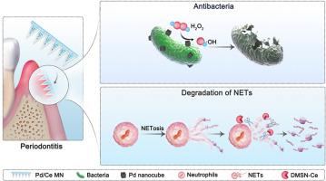 Dual nanozymes-loaded core-shell microneedle patches with antibacterial and NETs-degradation bifunctional properties for periodontitis treatment
