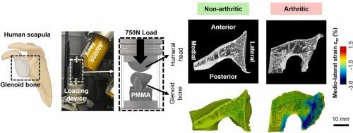 Full-field strain distribution in non-arthritic and arthritic glenoid bones before and after implant placement measured by digital volume correlation method