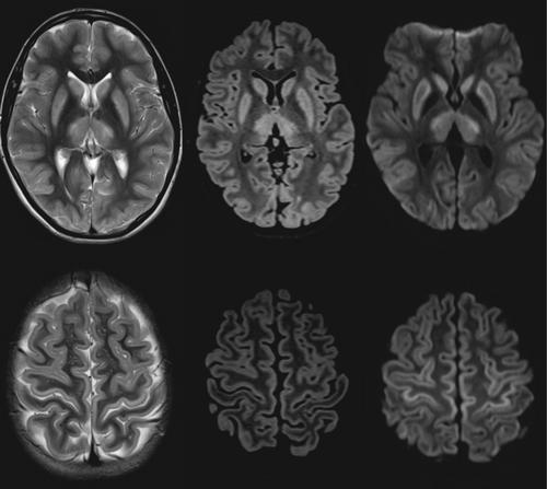 A Mild Juvenile Onset Canavan Disease With Atypical Clinical Presentation and MRI Brain Features