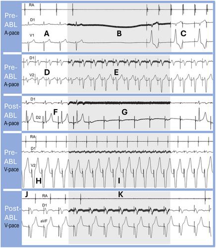 Extra-cardiac vagal stimulation: Clinical utility of a novel diagnostic and therapeutic tool in supraventricular tachycardia
