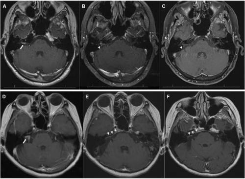 MRI Enhancement Patterns After Resection of Sporadic Vestibular Schwannoma: Comparing Retrosigmoid and Translabyrinthine Approaches