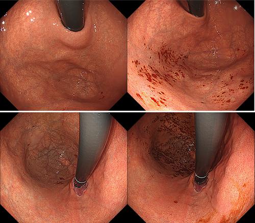 Complications of Endoscopic Pressure Study Integrated System: Review of 1205 Cases in 10 Years’ Experience