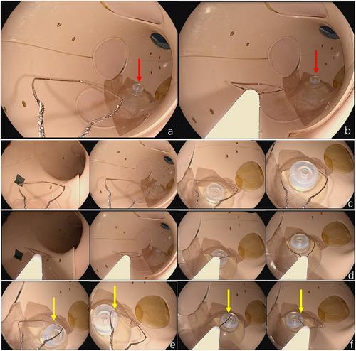 Improving Operator Depth Vision in Gastrointestinal Endoscopy: A Pilot Study of a New Three-dimensional Imaging System