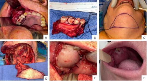 The Submental Island Flap for Reconstruction of Maxillectomy Defects in the Elderly