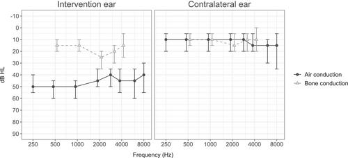 Disability, Quality of Life and Hearing Function in Patients With Untreated Otosclerosis
