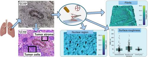Characterization of human non-small cell lung cancer histology samples by atomic force microscopy