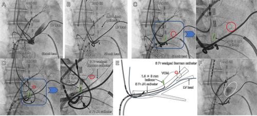 Successful Ethanol Infusion of Vein of Marshall With Bridge Collateral Using the Double-Balloon Technique Incorporating a Wedged Berman Catheter